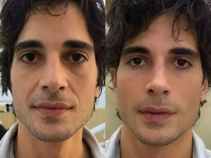 Fiuk destaca mudança no nariz após procedimento facial exibido no SBT